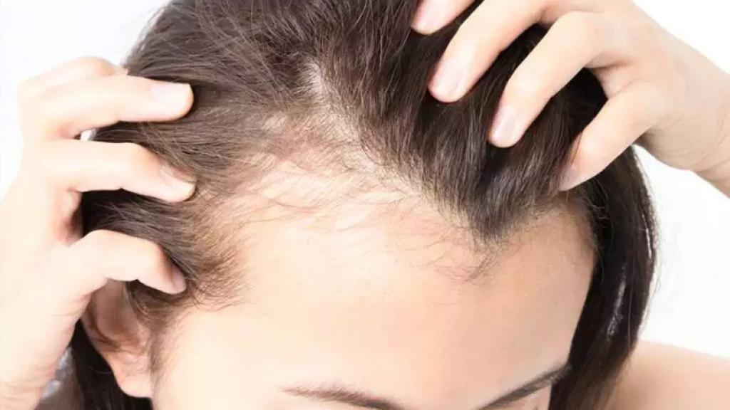Disminuye las molestias de la alopecia con estos consejos